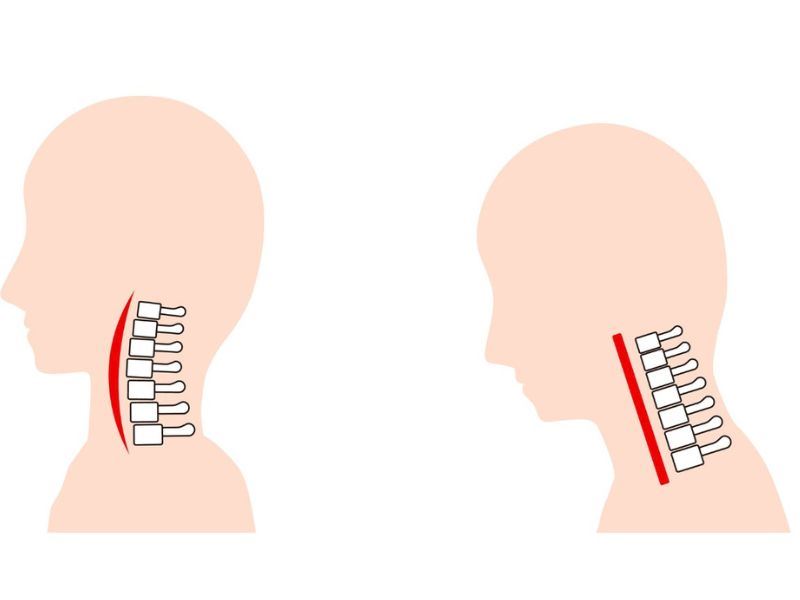 Boyun Düzleşmesi Nedir, Neden Olur?