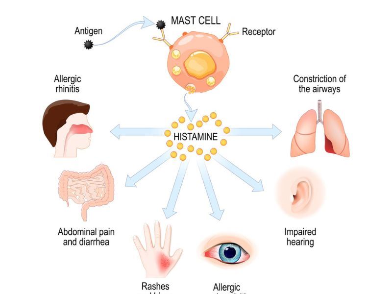 Histamin İntoleransı Nedir? Kimler Risk Altında?