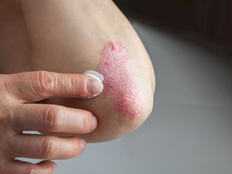 Sedef Hastalığını Tetikleyen 5 Besin